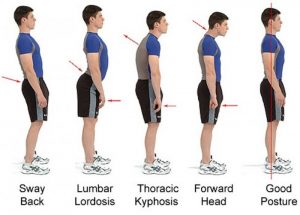 symptoms of bad posture