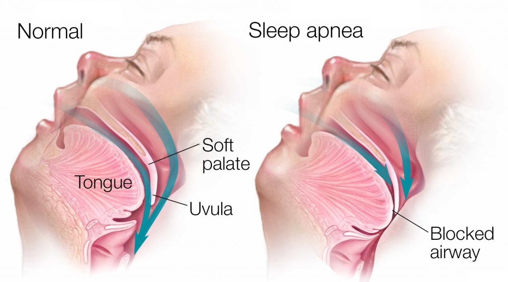 What is Sleep Apnea