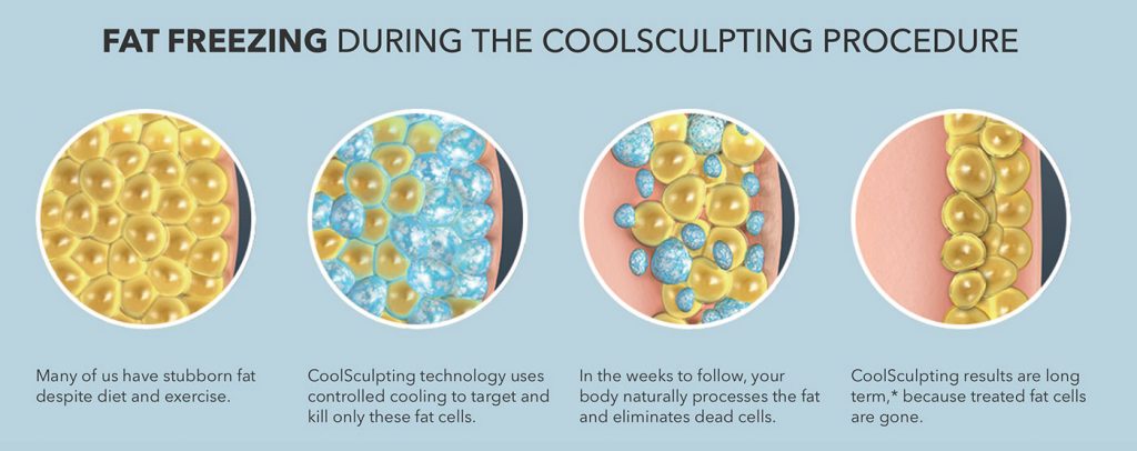 CoolSculpting procedure