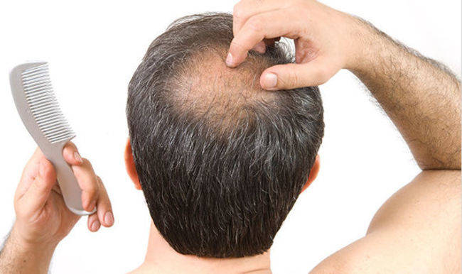 Man & hair loss