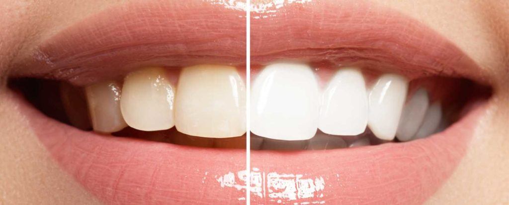 Avoid Stains On Teeth By Drinking Smartly